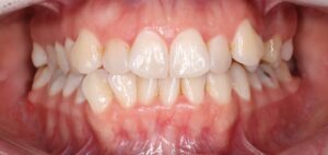 Apinhamento Severo / Falta de Espaço