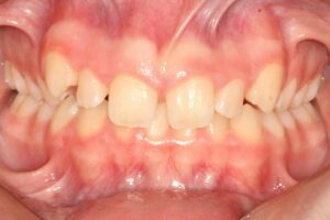 Diastemas - Espaço entre os dentes