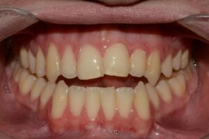 Mordida Aberta Adulto