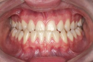 Mordida Cruzada Anterior