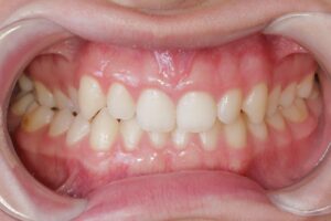 Mordida Cruzada Posterior Direita Adulto