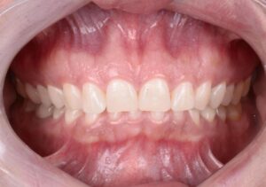 Mordida Profunda Adulto